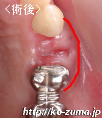 歯周病で骨がやせた場合のインプラント手術