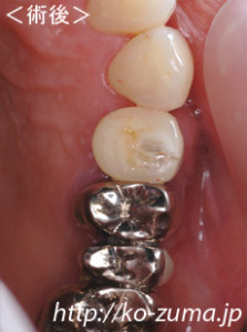 歯周病で骨がやせた場合のインプラント手術