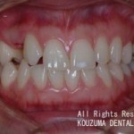 元から歯がない場合のインプラント