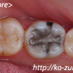 2012年銀歯を自然に白くしたい方