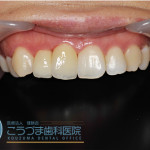 矯正器具を使わずに歯並びをキレイにしたい