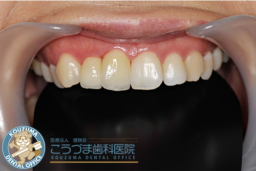 矯正器具を使わずに歯並びをキレイにしたい