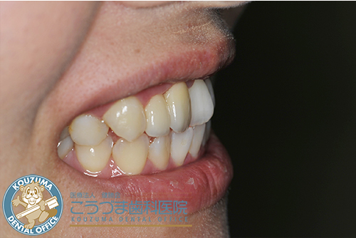 矯正器具を使わずに歯並びをキレイにしたい