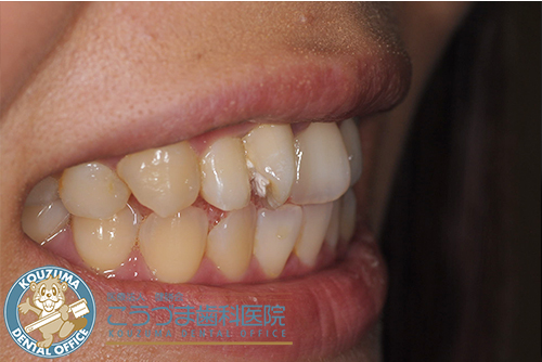 矯正器具を使わずに歯並びをキレイにしたい