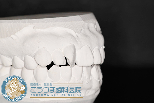 矯正器具を使わずに歯並びをキレイにしたい　ワックスモールド