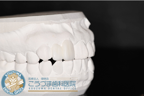 矯正器具を使わずに歯並びをキレイにしたい　ワックスモールド