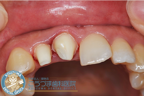 矯正器具を使わずに歯並びをキレイにしたい