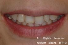 セラミックによる治療、銀のバネがない義歯