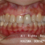 セラミックによる治療、銀のバネがない義歯