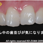セラミックを使った前歯の歯並びの治療