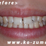 歯と歯のすき間を埋めたい　歯を削らずに歯並びを改善