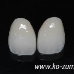 前歯のコンプレックスを解消！ホワイトニングとセラミックで笑顔に