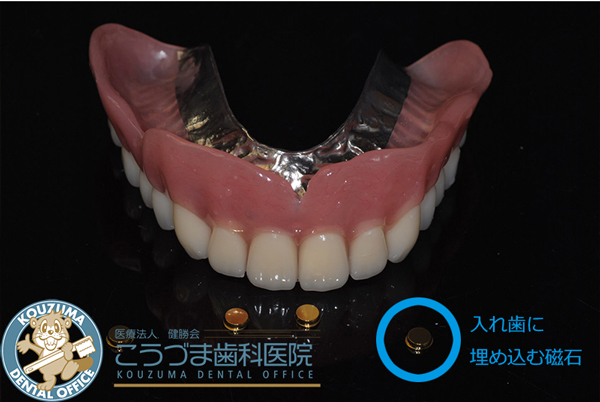 鹿児島の歯医者　違和感のない総入れ歯　インプラント義歯