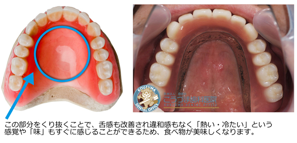 鹿児島の歯医者　違和感のない総入れ歯　インプラント義歯